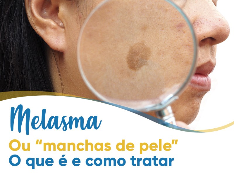 Melasma: o que  e como tratar